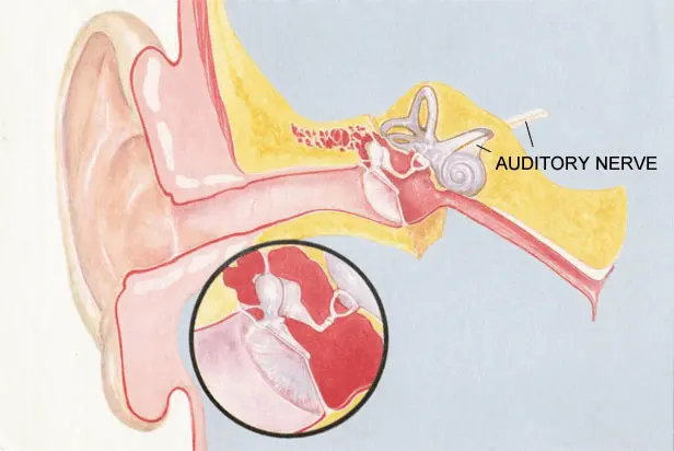 Sonus Complete Auditory Nerve